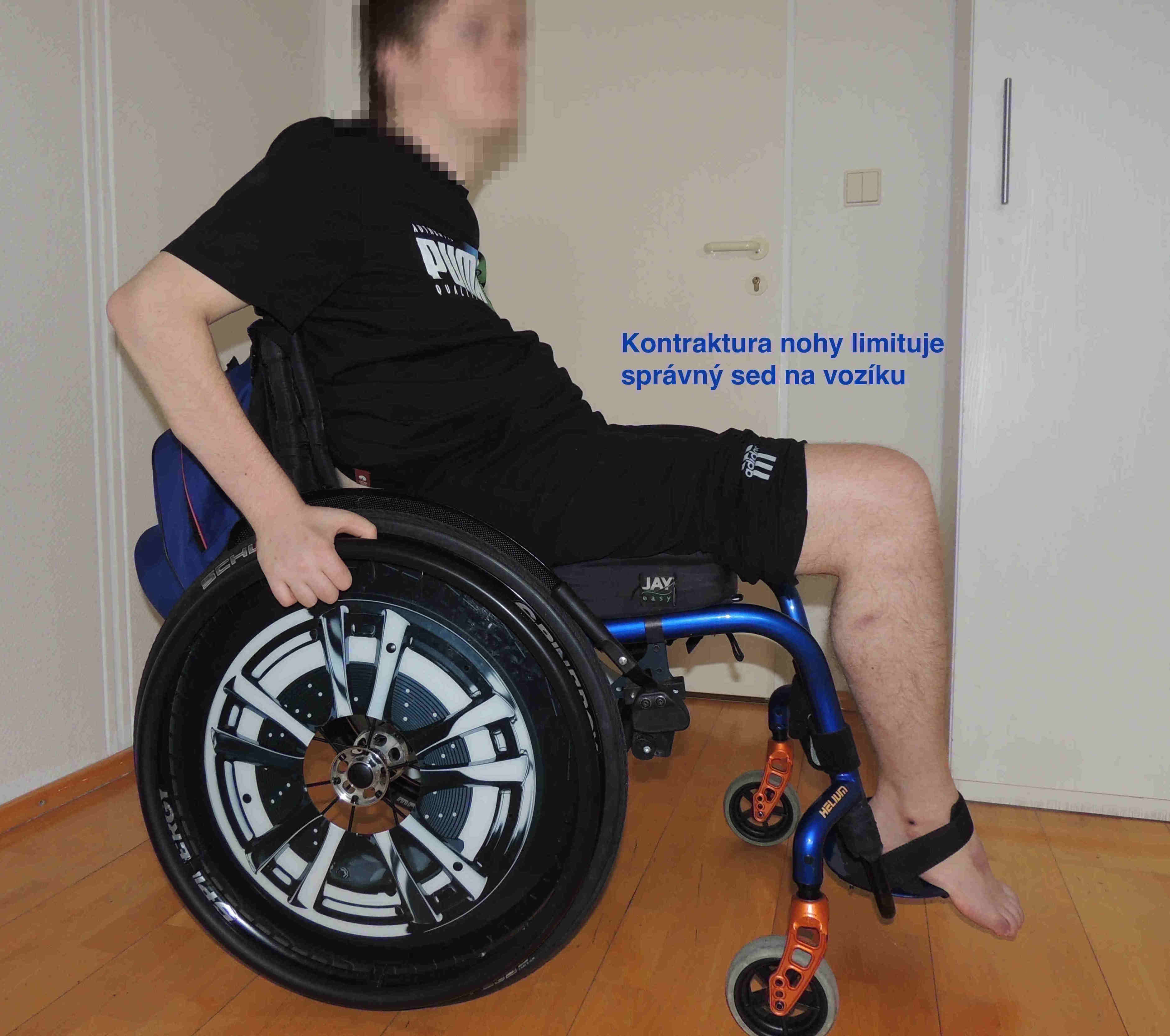 Kontraktura nohy